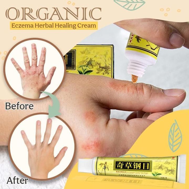 Organic Eczema Herbal Healing Cream 🔥 50% OFF - LIMITED TIME ONLY 🔥
