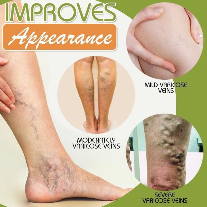 Vein Treatment Cream Spider Leg Repair Cream