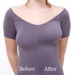 Bare Lifts - The Instant strapless Breast Lift
