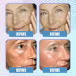 LIFTIN™ : Hyaluronic Acid Microcrystalline Lifting Decree Patches (5 PAIRS)