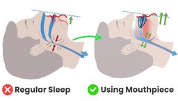 Anti-Snoring Mouthpiece