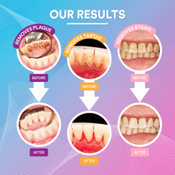 Ultrasonic Tooth Cleaner