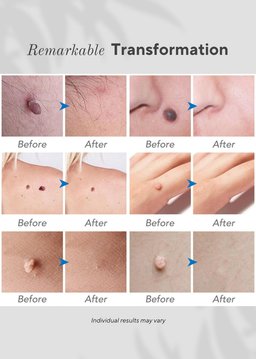 6-in-1 Skin Imperfection Removal Pen