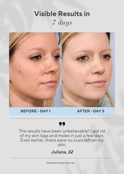 6-in-1 Skin Imperfection Removal Pen