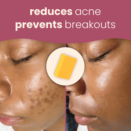 kojic acid & turmeric soap bar