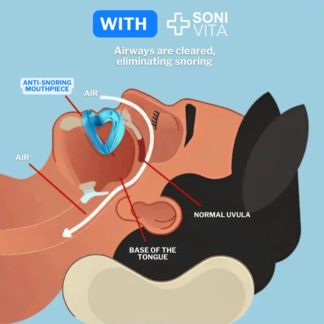 Sonivita Anti-snoring Mouthpiece Universal Size